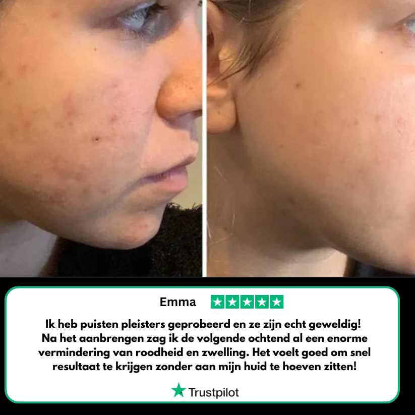 Acne-Puisten Pleisters